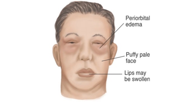 هرآنچه که باید در مورد سندرم نفروتیک بدانیم هرآنچه که باید در مورد سندرم نفروتیک بدانیم